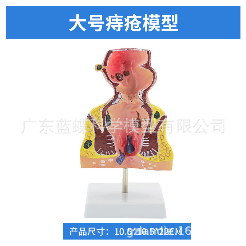 Large / Rectal Hemorrhoid