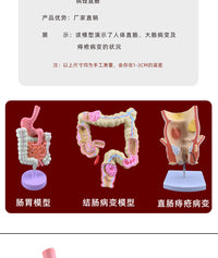 人体大肠病理模型 肠胃解剖模型 病态大肠盲肠 直肠 十二指肠模型