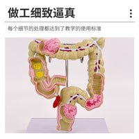 教学仿真人体大肠病理模型肠胃直肠痔疮病变解剖肠道疾病结肠病变