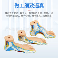 正常足 扁平足 弓型足 模型 足部病理模型人体足部肌肉解剖模型