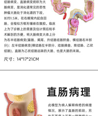 人体大肠病理模型 肠胃解剖模型 病态大肠盲肠 直肠 十二指肠模型