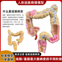 人体大肠病理模型 肠胃解剖模型 病态大肠盲肠 直肠 十二指肠模型