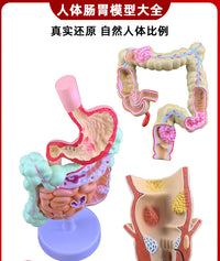 人体大肠病理模型 肠胃解剖模型 病态大肠盲肠 直肠 十二指肠模型