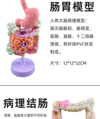 人体大肠病理模型 肠胃解剖模型 病态大肠盲肠 直肠 十二指肠模型