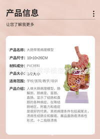 教学仿真人体大肠病理模型肠胃直肠痔疮病变解剖肠道疾病结肠病变