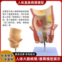 人体大肠病理模型 肠胃解剖模型 病态大肠盲肠 直肠 十二指肠模型