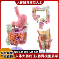 人体大肠病理模型 肠胃解剖模型 病态大肠盲肠 直肠 十二指肠模型