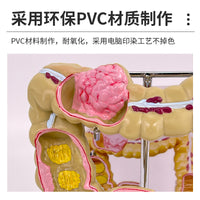 教学仿真人体大肠病理模型肠胃直肠痔疮病变解剖肠道疾病结肠病变
