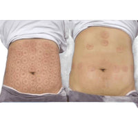 Thickened Magnetic Acupuncture Cupping Therapy Set