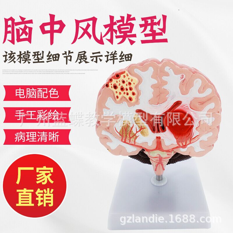 Human Brain Anatomy Model for Stroke and Brain Disease Education