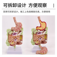 教学仿真人体大肠病理模型肠胃直肠痔疮病变解剖肠道疾病结肠病变