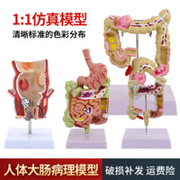 教学仿真人体大肠病理模型肠胃直肠痔疮病变解剖肠道疾病结肠病变