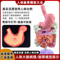 人体大肠病理模型 肠胃解剖模型 病态大肠盲肠 直肠 十二指肠模型