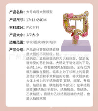 教学仿真人体大肠病理模型肠胃直肠痔疮病变解剖肠道疾病结肠病变